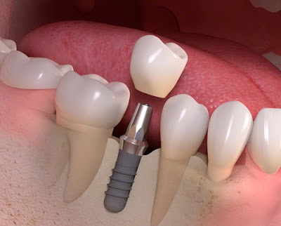 Trồng răng giả hết bao nhiêu tiền với Implant? Trồng răng giả hết bao nhiêu tiền với Implant?