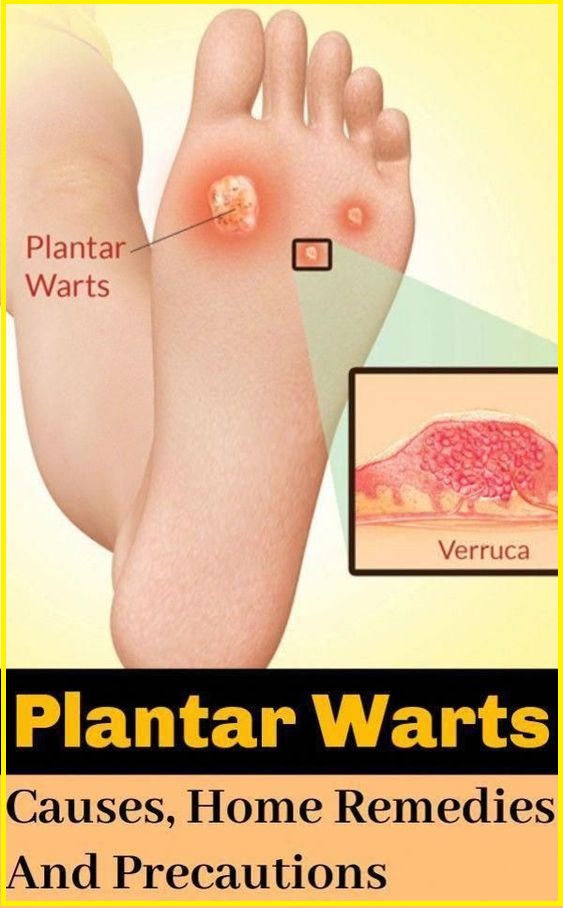 How to Treat Plantar Warts at Home Naturally wellness days
