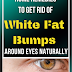 Home Remedies to Get Rid of White Fat Bumps Around Eyes Naturally