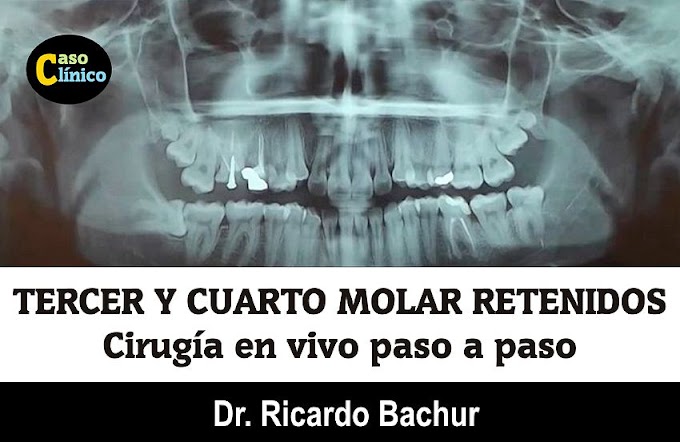 MOLARES RETENIDOS: Cirugía de 3er y 4to Molar - Caso Clínico del Dr. Ricardo Bachur