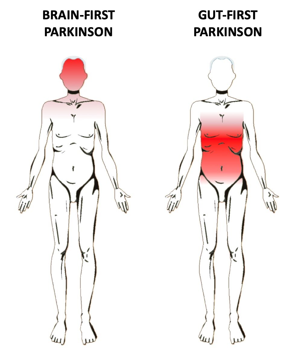 Our Parkinson's Place: Where does Parkinson's disease start: In the ...