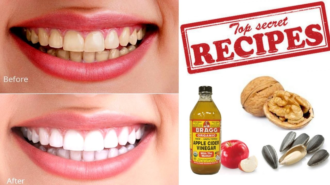 Remove Tartar From Teeth Baking Soda TeethWalls