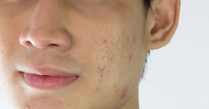 Doa Menghilangkan Jerawat Dan Bisul Menurut Islam Abu Syuja