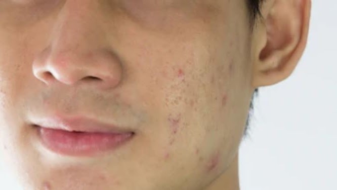 Ust Dhanu Bantu Doa Untuk Menyembuhkan Jerawat Penuh Di Muka Siraman Qolbu 5 11 Youtube