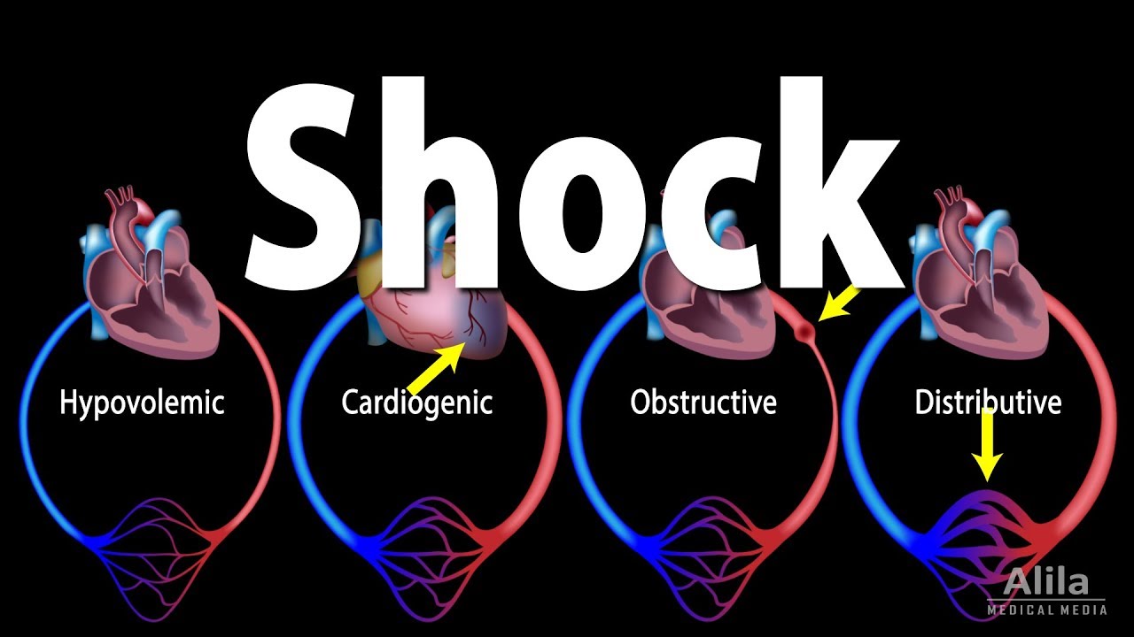 Cardiogenic Shock Adalah Homecare24