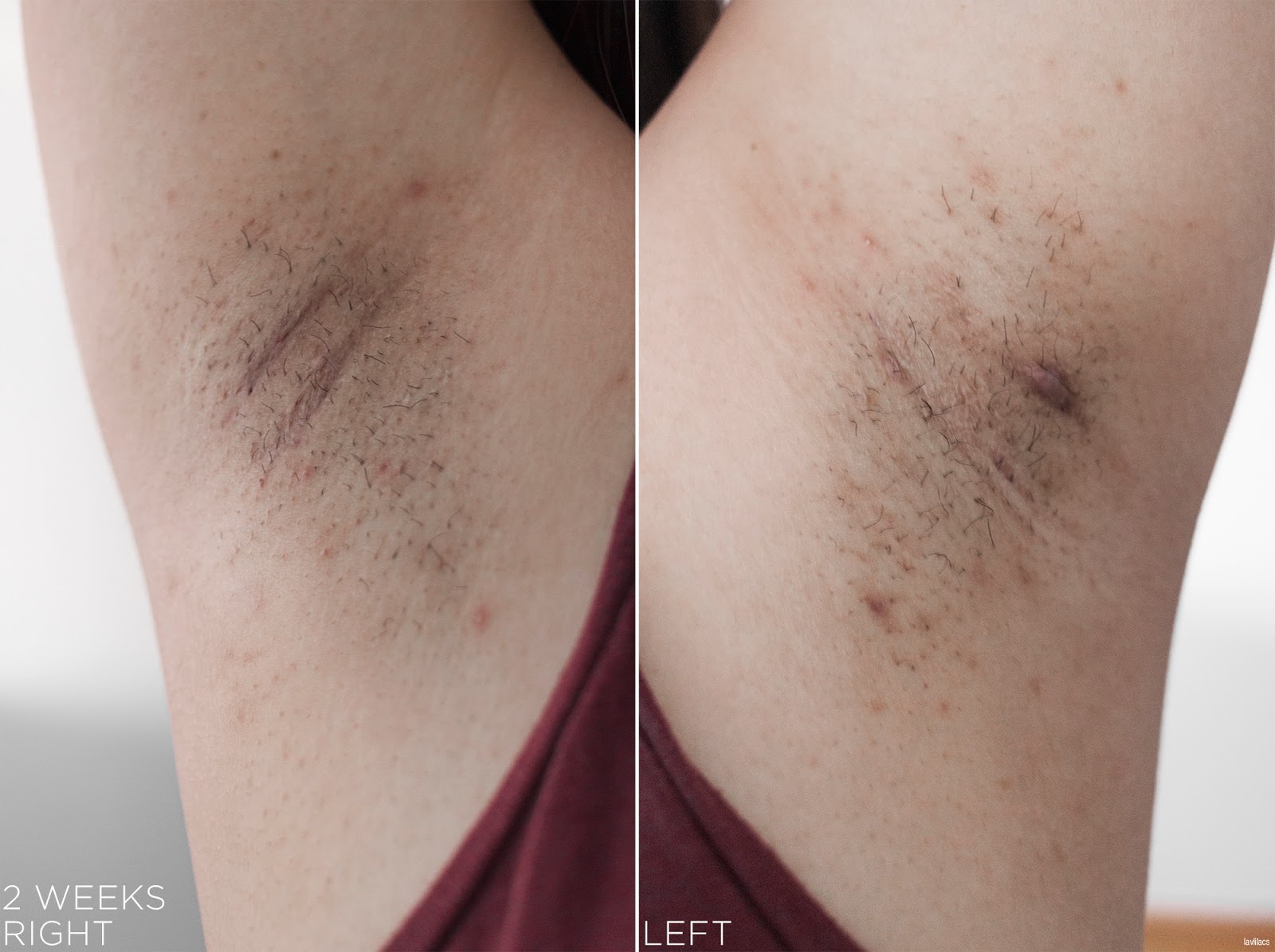 tria Hair Removal Laser Armpits Hair 2 Weeks