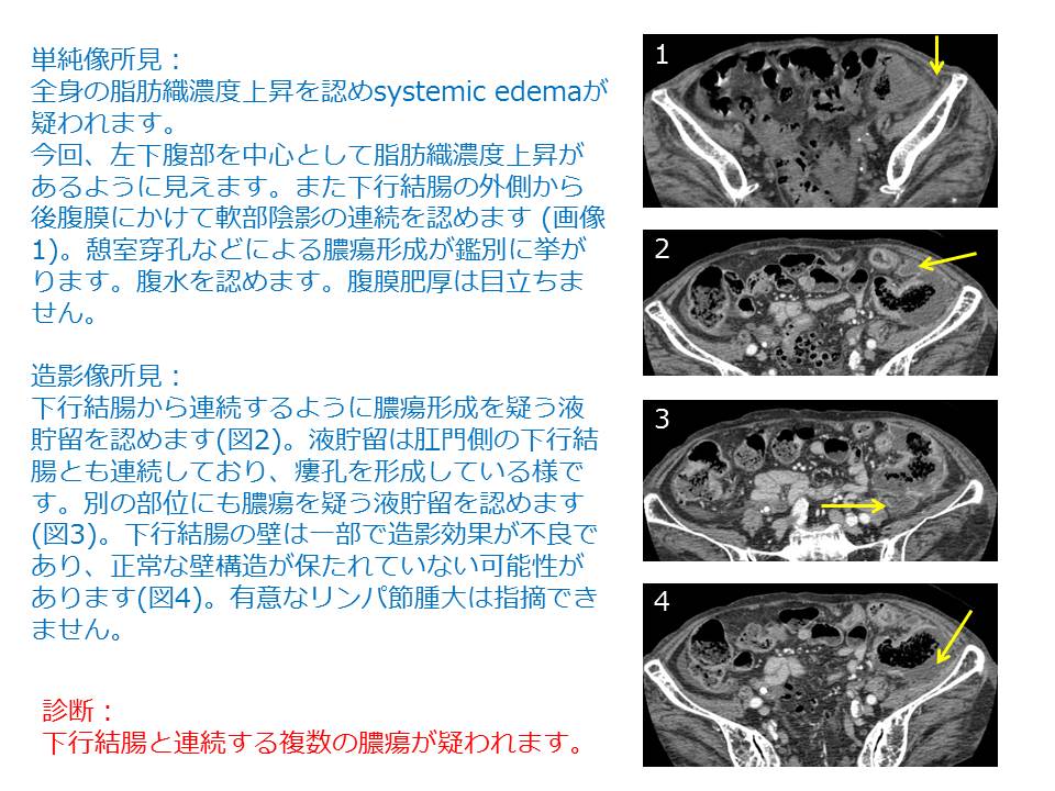 左下 腹部 痛み