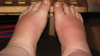 Swollen Feet and Ankles Causes