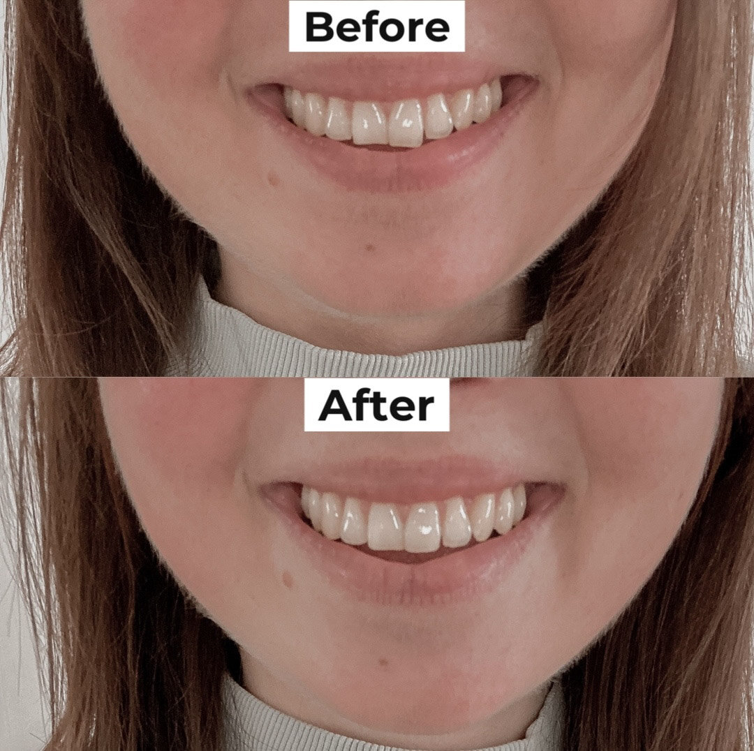 Teeth Contouring My Experience Lucy Mary