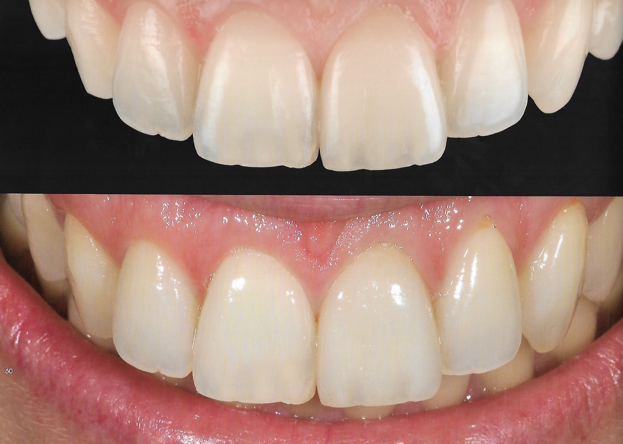 Why lithium disilicate (IPS e.max) for veneers? Dental Esthetics