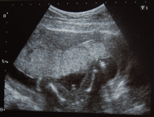 17 недель мальчик. УЗИ беременности 16-17 недель мальчик. УЗИ 17 недель беременности. Плод в 17 недель беременности УЗИ плода.