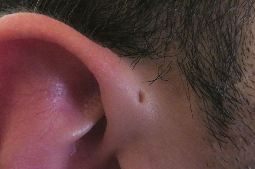 Some people are born with tiny holes above their ears, and here's why
