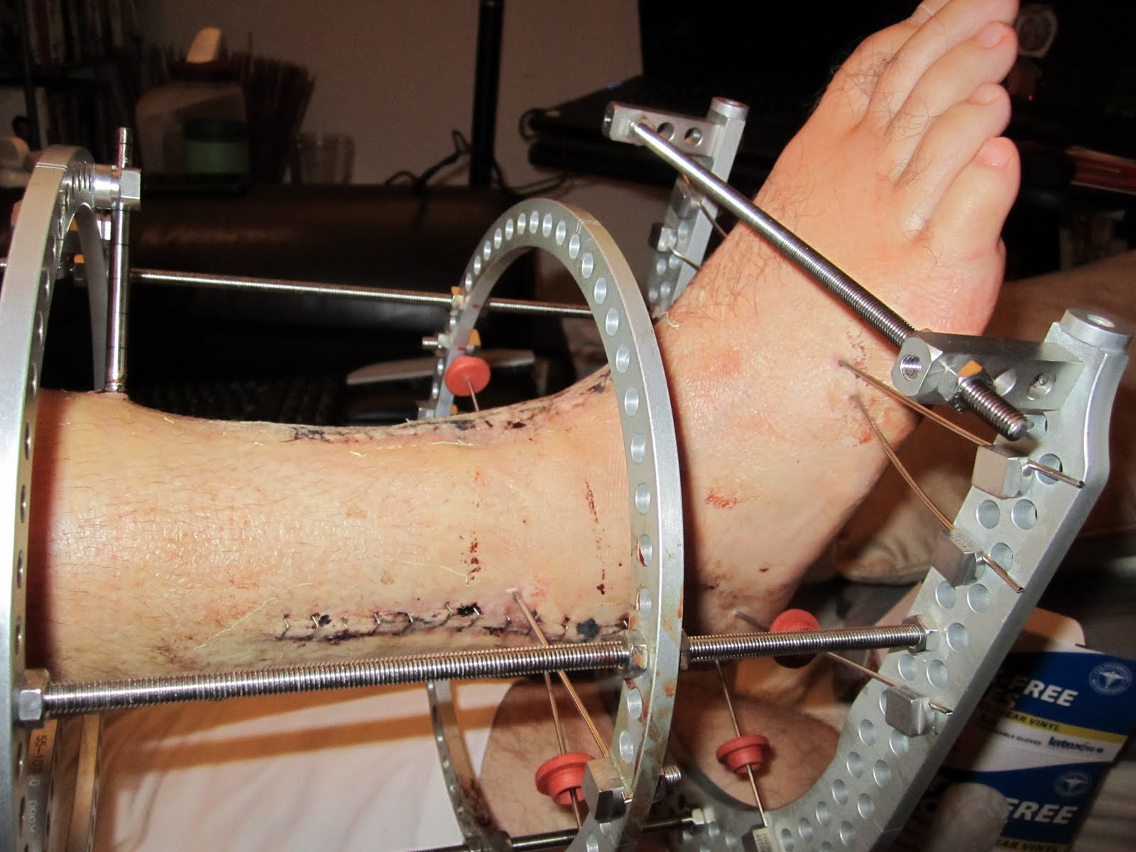 Snowboarder vs. Tree Preparing for Your First External