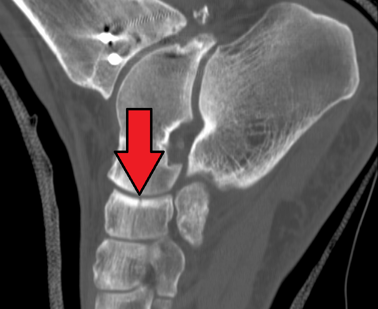 Navicular Fracture Treatment Navicular Bone Fracture Surgery