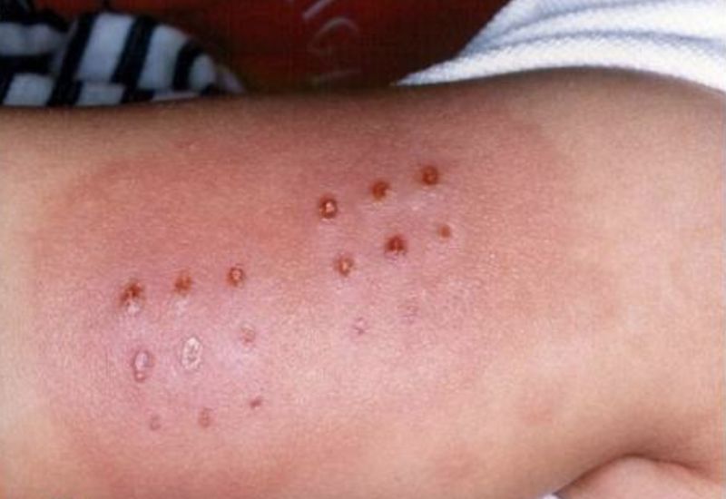 How to Manage Food Allergies | Mahapatra Hospital Cuttack