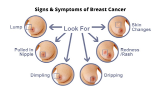 ಸ್ತನ ಕ್ಯಾನ್ಸರನಿಂದ ಹುಷಾರಾಗಿರಿ : Breast Cancer in Kannada