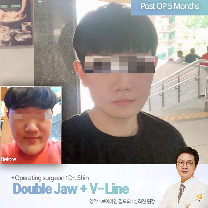 Lantern Jaw improve with jaw surgery in Korea _ EU