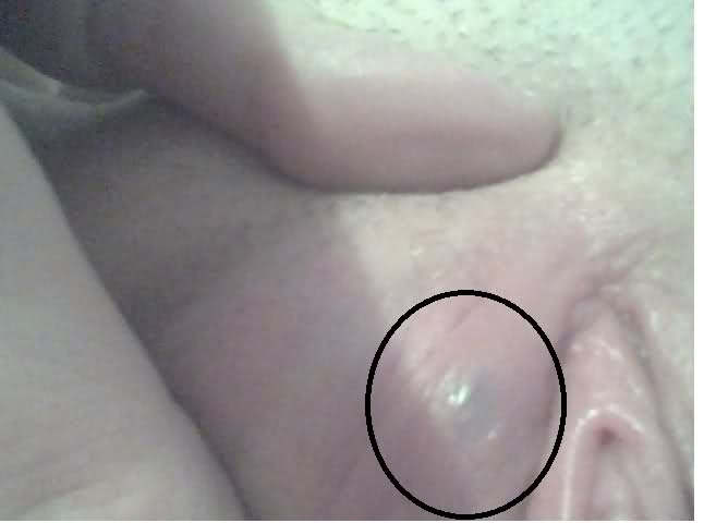 Pussy Cysts 64