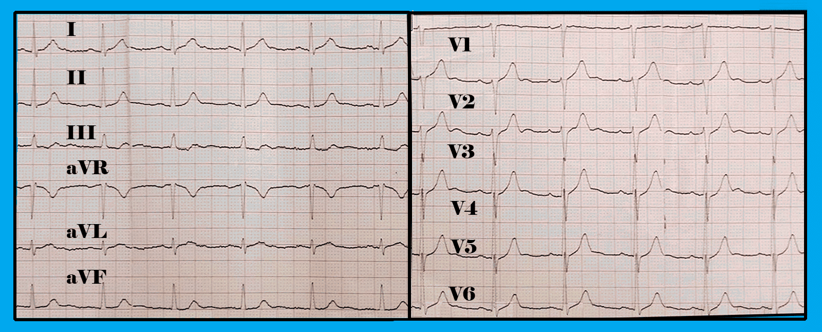 Отрицательный коронарный зубец т в v1-v3. Зубец р отражает процессы. Зубец т в avr. Зубец т 2 3. Зубец т 2 3.