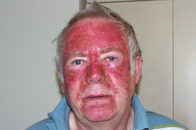 Alan's Efudix/Efudex Experience