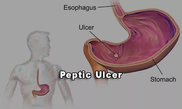What is peptic ulcer? - causes, symptoms, complications, treatment