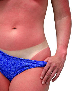 Sunburn Remedies