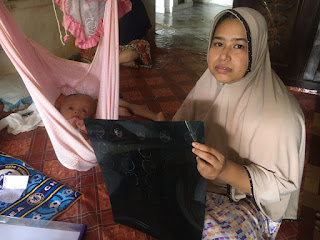 Bayi Asal Aceh Timur Penderita Hidrosefalus Butuh Uluran Tangan Dermawan Agustus 23, 2021