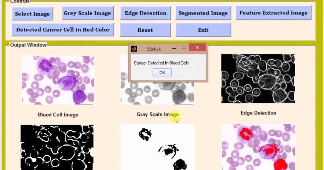 Leukemia Detection from Blood Cells using Image Processing Matlab ...