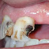 ¿Que son las caries en los dientes y como evitarlas?