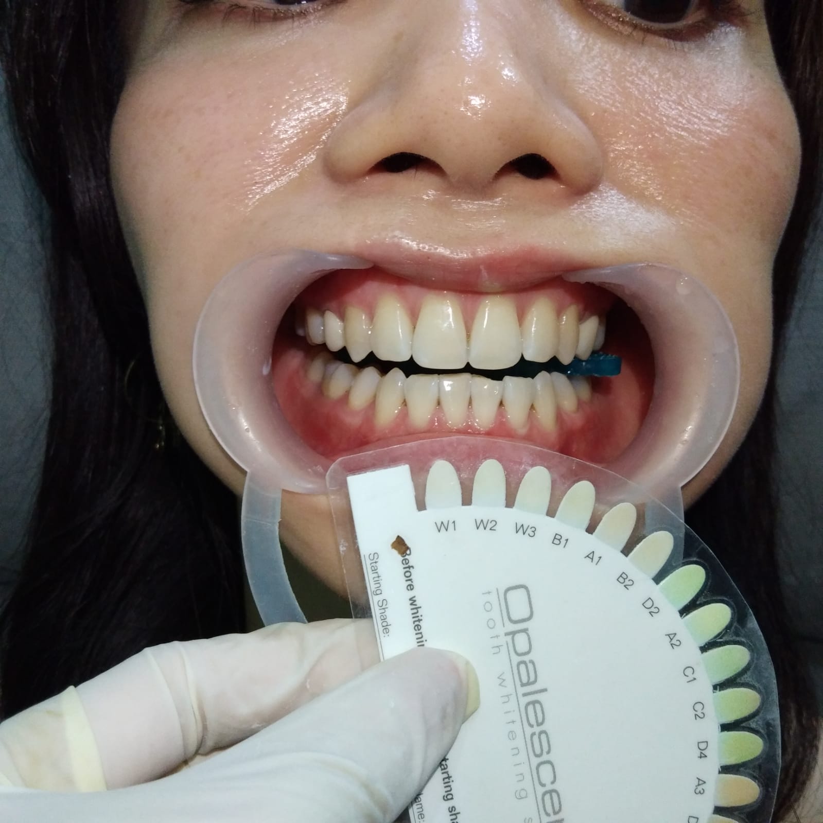 Scaling & Treatment Whitening gigi di J•Smile Dental Tomang, Klinik Gigi Jakarta