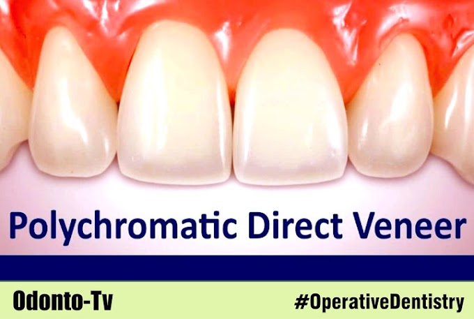 OPERATIVE DENTISTRY: Polychromatic Direct Veneer with Dr. Newton Fahl