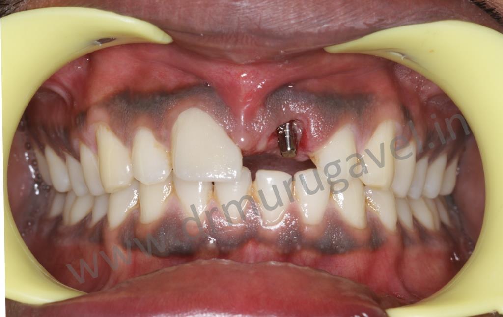 Front infected central incisor post accidentremoval and replacement with same day dental