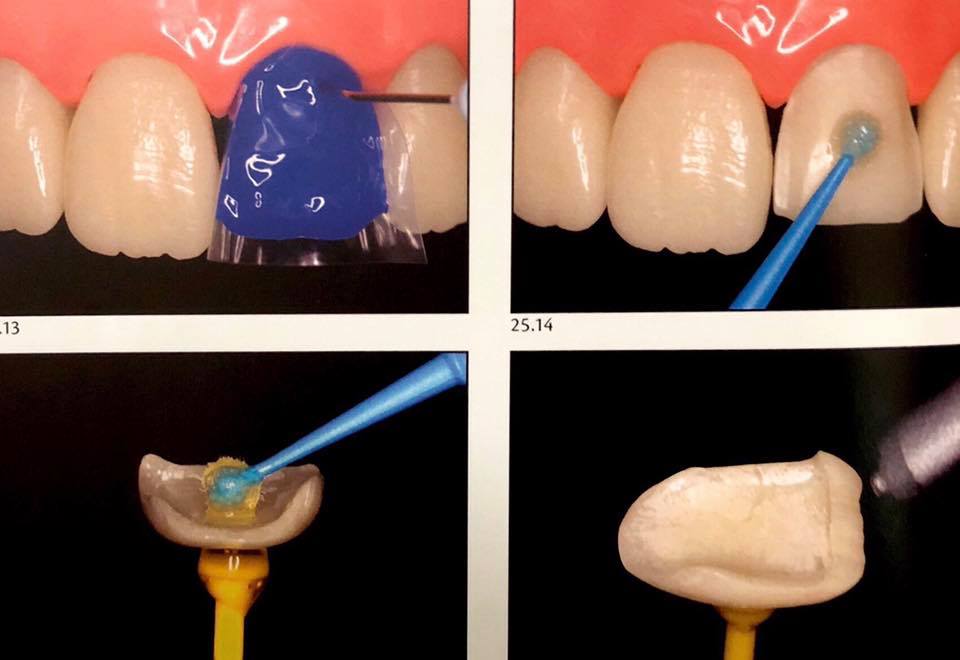 Adhesive cementation " emax cementation protocol “ Dental Esthetics