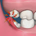 Răng khôn mọc thẳng có đau không?