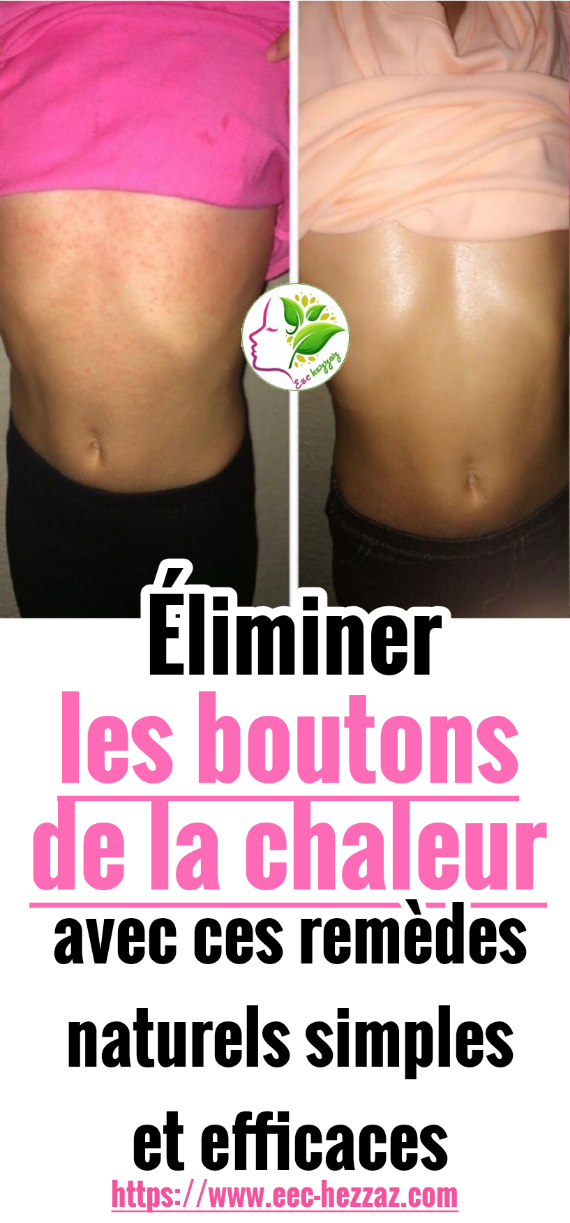 Éliminer les boutons de la chaleur avec ces remèdes naturels simples et efficaces