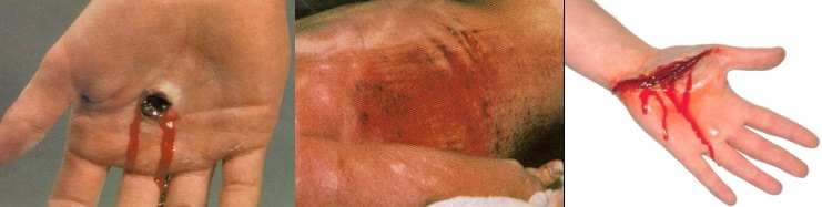 Sistem Hastalıkları ve İlk Yardım: İlk Yardım (Yara Çeşitleri)