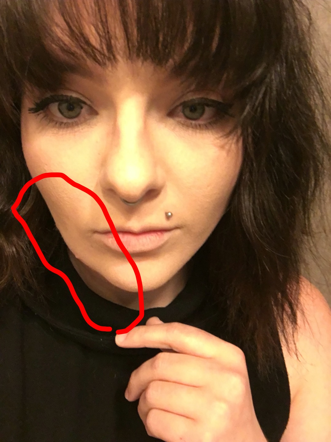 Mr. ZIT CRAZY FACE INFECTION (Staph on face)