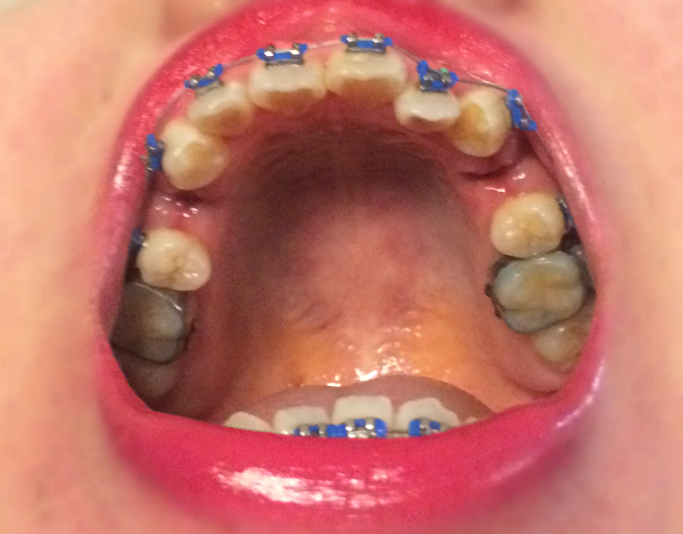 MY BRACES JOURNEY [PART 2]