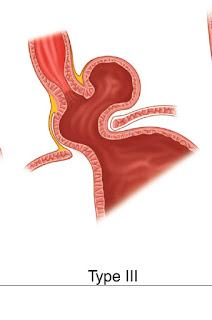 A type III hiatal hernia, with the antrum of the stomach well above the diaphragm.