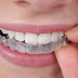 Modern methods of whitening your teeth
