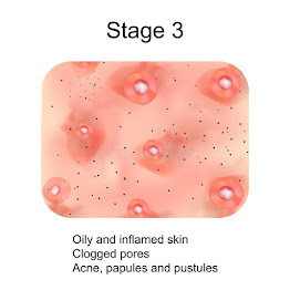 stage 3 acne