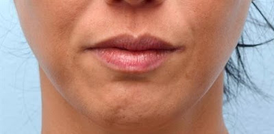 chin dimpled treatment