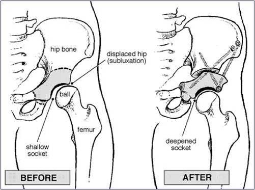 orthopedic chirugus: OSTEOTOMIES AROUND HIP