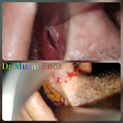 Nasal Septum Perforation Closure - Treatment in Turkey Istanbul