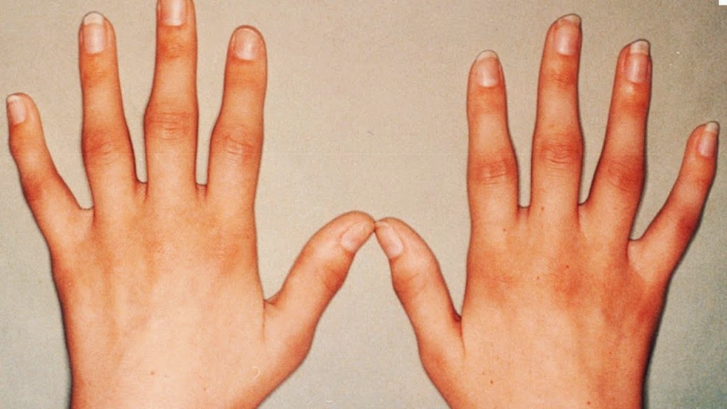 ¿Artritis reumatoides Que Es La Artritis, Síntomas Artritis Reumatoide? la salud es primero ¿Artritis reumatoides Que Es La Artritis, Síntomas Artritis Reumatoide? la salud es primero