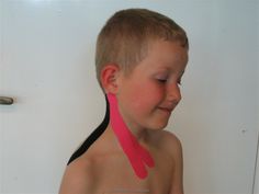 Kinesio Taping for Torticollis Torticollis Treatment using Kinesio Tape