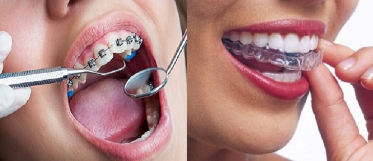 Dental Braces and Retainers