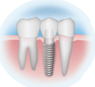 Để chân răng nhân tạo tốt như chân răng sinh lý cần thực hiện tại địa chỉ ghép răng Implant tốt nhất
