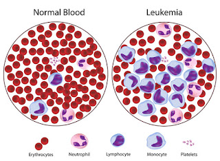 Kenali Ciri-Ciri dan Gejala Penyakit Leukemia - Milagros Online
