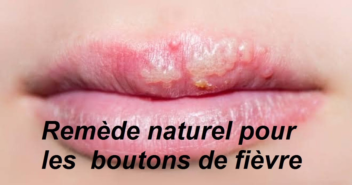Bouton de fièvre Remède naturel efficace et rapide Sport et Santé